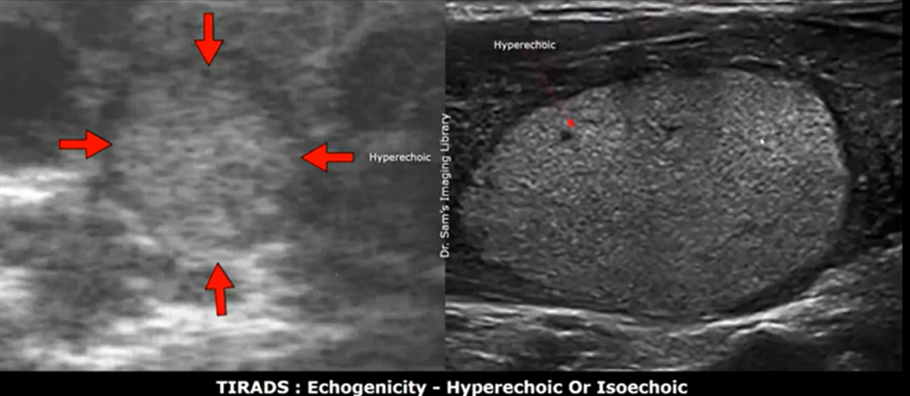 Early stage thyroid cancer ultrasound images