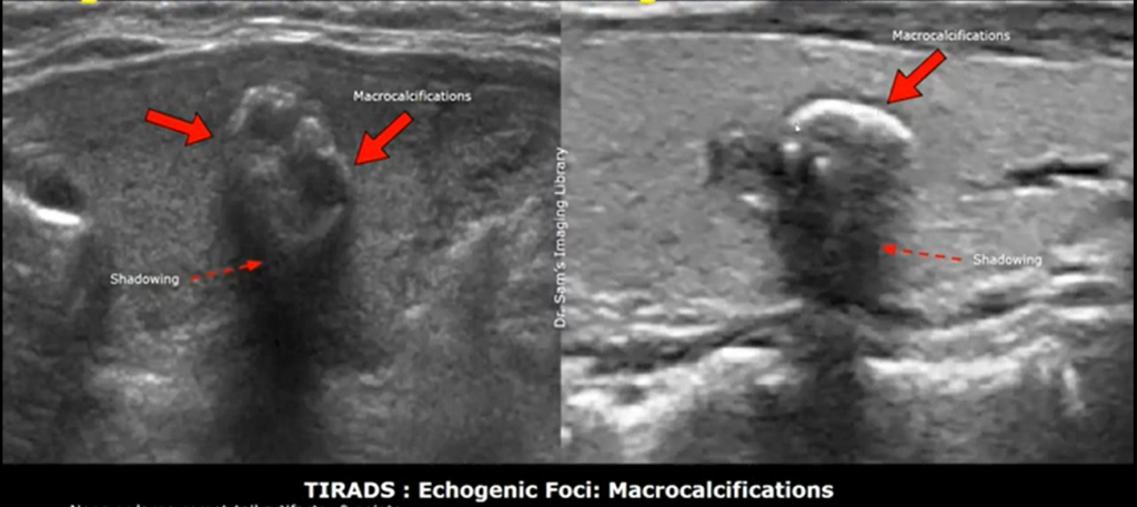 Early stage thyroid cancer ultrasound images