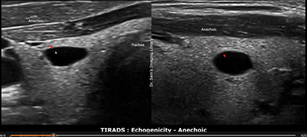 Early stage thyroid cancer ultrasound images