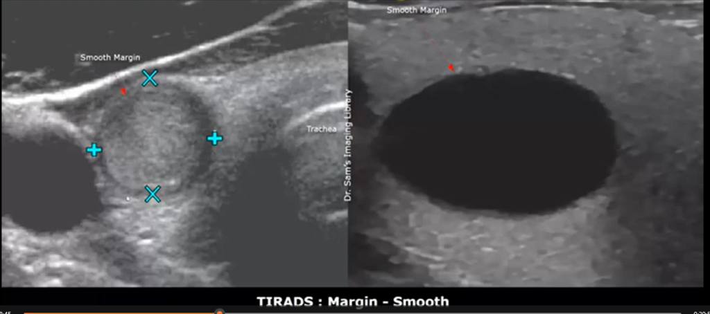 Early stage thyroid cancer ultrasound images