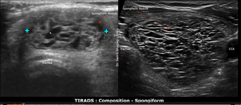 Tirads Calculator - Tirads Calculator