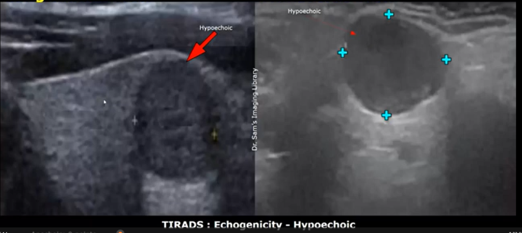 Early stage thyroid cancer ultrasound images