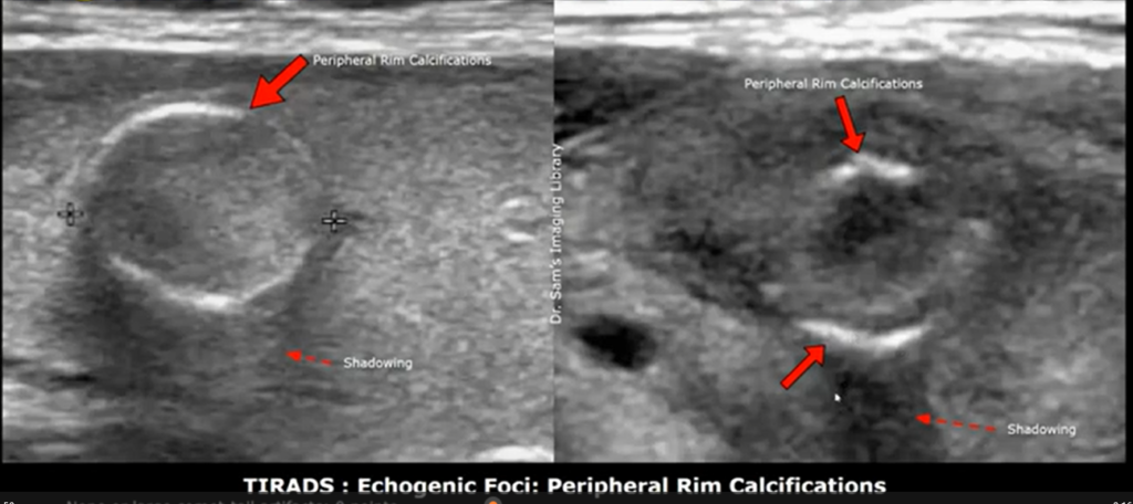 Early stage thyroid cancer ultrasound images