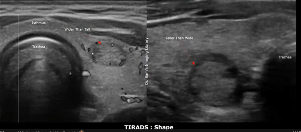 Early stage thyroid cancer ultrasound images