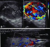 What color is thyroid cancer on ultrasound