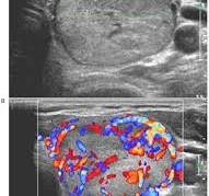 What color is thyroid cancer on ultrasound
