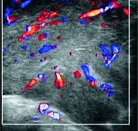 Lymphoma Thyroid Cancer Ultrasound Colors