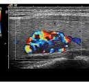 Lymphoma Thyroid Cancer Ultrasound Colors