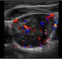 Lymphoma Thyroid Cancer Ultrasound Colors