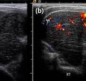 Lymphoma Thyroid Cancer Ultrasound Colors