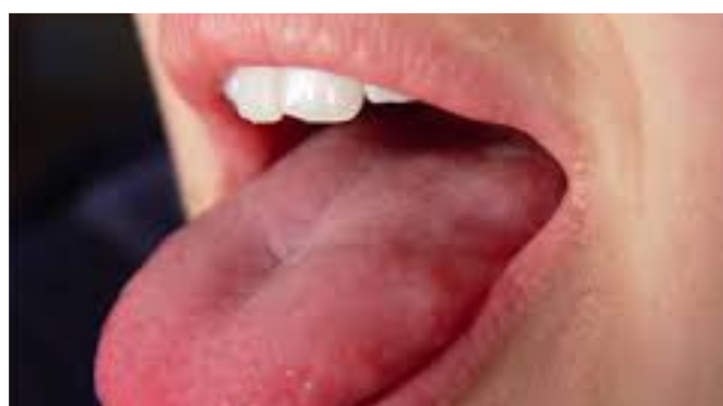 Thyroid Tongue Pictures