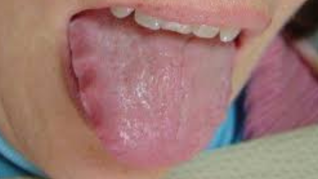 Thyroid Tongue Pictures