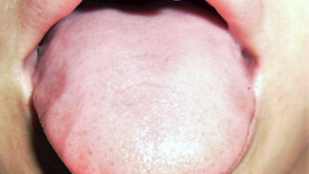 Thyroid Tongue Pictures
